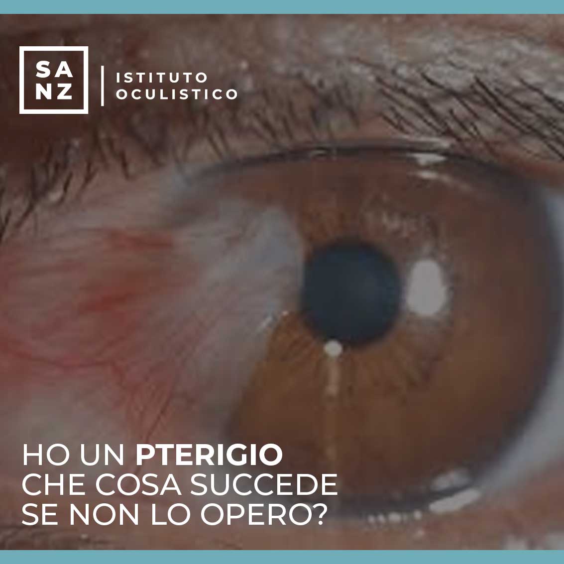 Ho un Pterigio, che cosa succede se non lo opero?