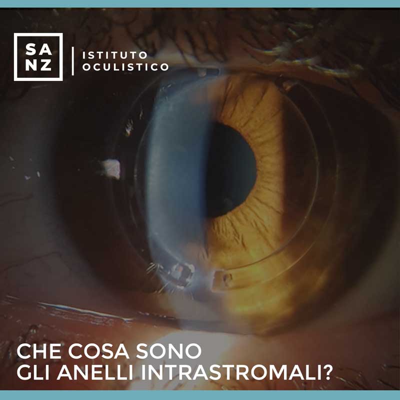 Che cosa sono gli anelli intrastromali?